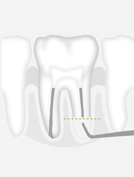 W&H R1D — Тонкая насадка с алмазным покрытием для ретроградной обработки корневого канала.