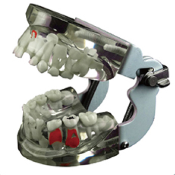 Jingle JG-Y13 — Фантомная прозрачная модель детских зубов с патологиями