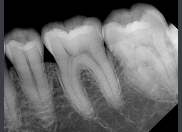 RIOSensor RIS500 - цифровой радиовизиограф 4.jpg