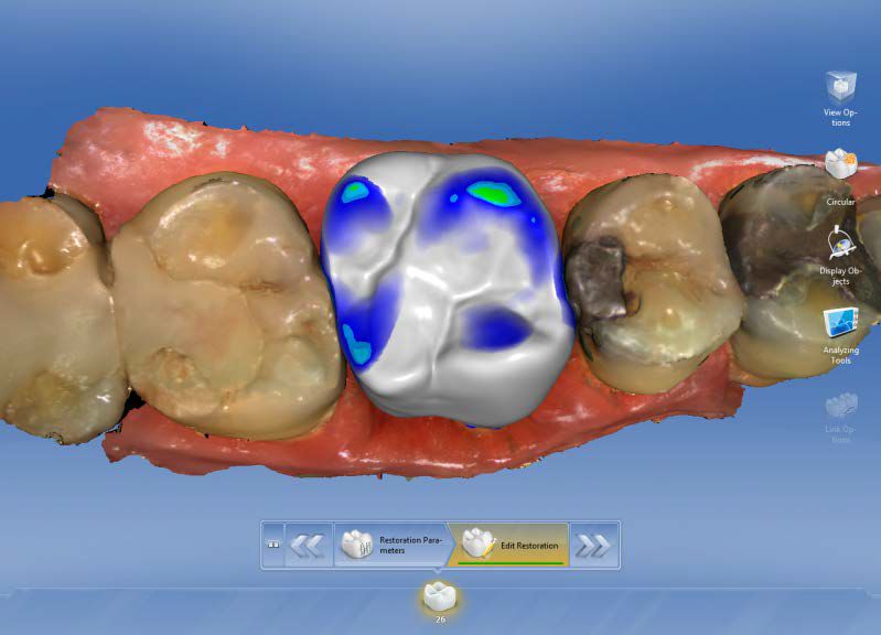 CEREC AC OMNICAM ПРОСТОЕ СКАНИРОВАНИЕ БЕЗ АНТИБЛИКОВОГО СПРЕЯ 7.jpg