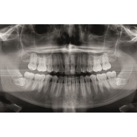 KaVo Pan eXam Plus Ceph - универсальный датчик Pan/Ceph для панорамной томографии, цефалостат, возможность дооснащения функцией 3D-томографии 6x8 см