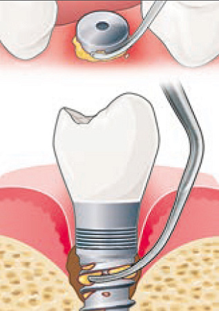 Acteon насадка IP1 – для обработки крупной резьбы имплантатов, абатментов
