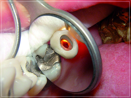 Hahnenkratt Mega FS 5 — Зеркала родиевые №5, упаковка 12 шт