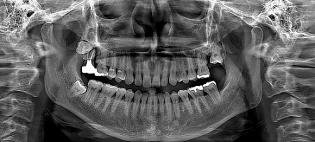Ray RAYSCAN Alpha P – ортопантомограф