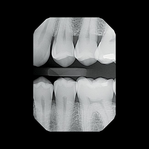 KaVo Gendex GXS-700 - система компьютерной радиовизиографии (сенсор №1)