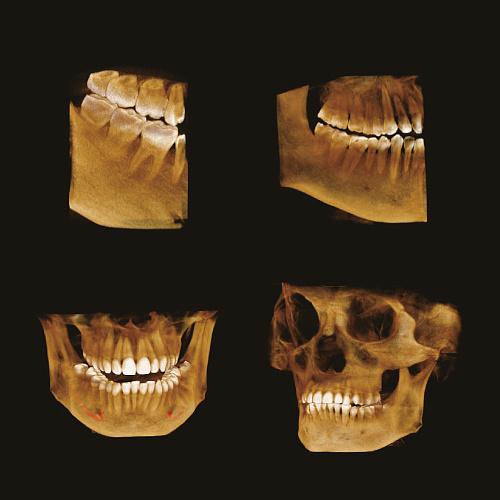 GENORAY Papaya 3D 23x24 - компьютерный томограф 