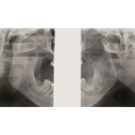 KaVo Pan eXam Plus Ceph - универсальный датчик Pan/Ceph для панорамной томографии, цефалостат, возможность дооснащения функцией 3D-томографии 6x8 см