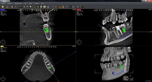 Owandy I-Max Touch 3D – Конусно-лучевой томограф 9х8